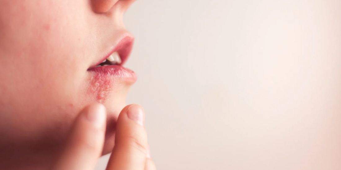 Person with skin rash near mouth.