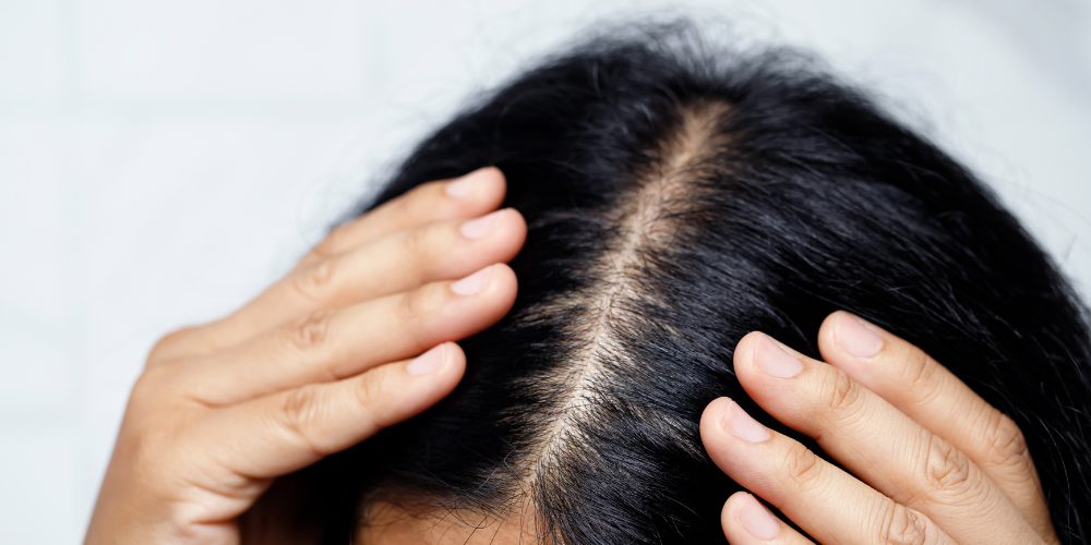 A person holding her hair in place, exposing the scalp.