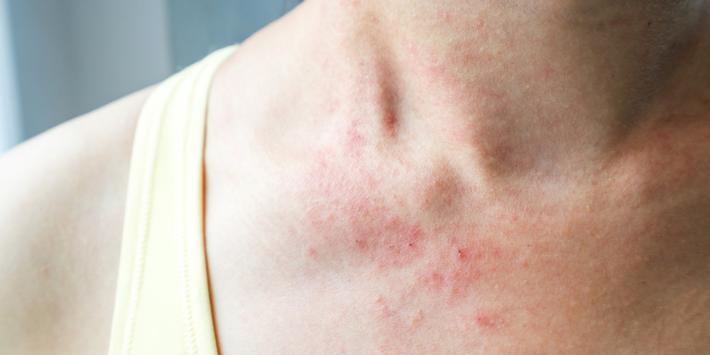 The Itchy Side of Estrogen: Understanding and Managing Estrogen Rash ...