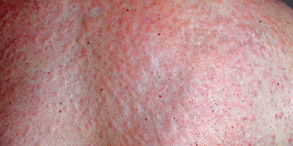 menopause rash picture