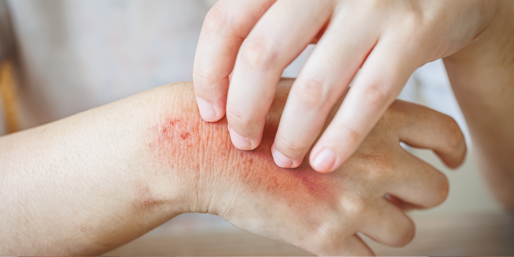 How to Soothe Itchy Skin During Perimenopause lubracil