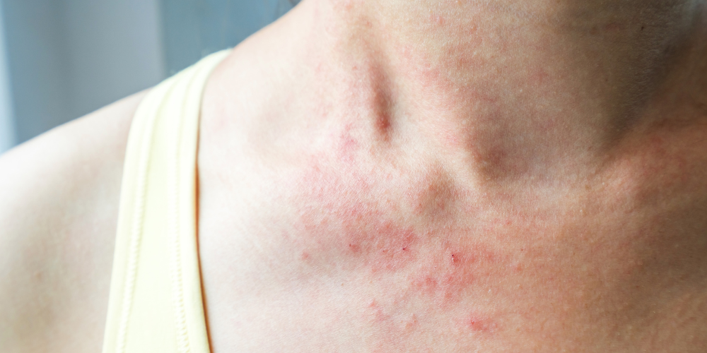 Menopause Rash Pictures: What They Look Like & Why – Lubracil