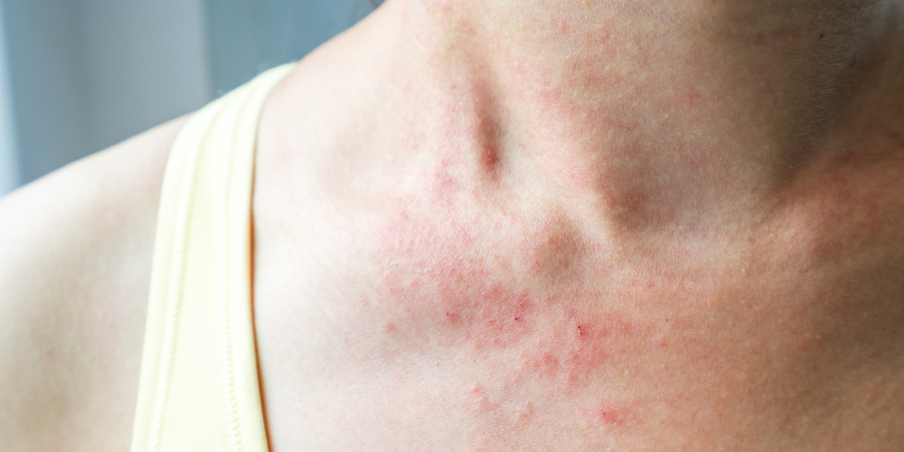 close up of a person's chest and neck red spots