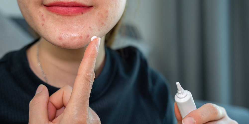 a woman putting on treatment to her acne