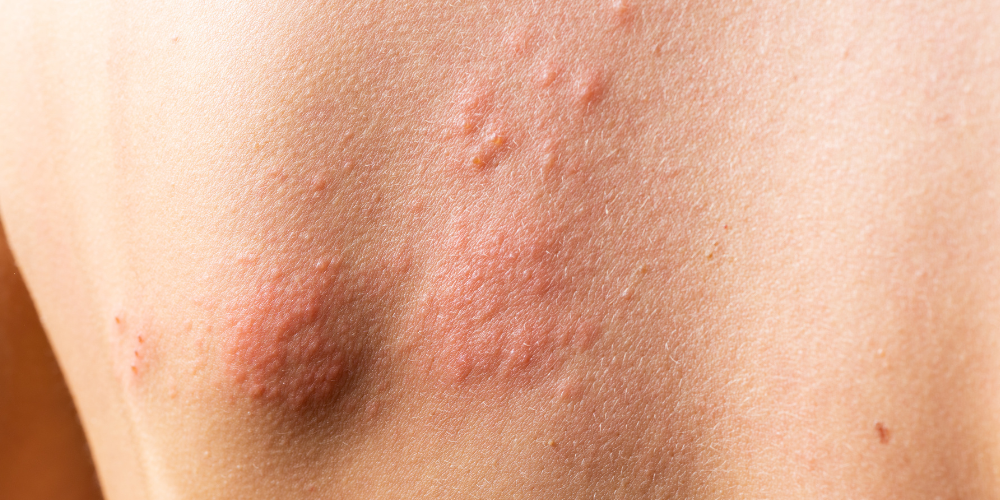 What Are Menopause Hives? Signs, Causes & Relief – Lubracil